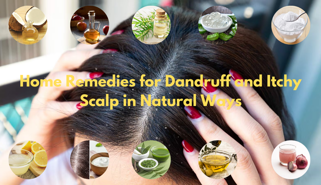 natural remedies for dandruff