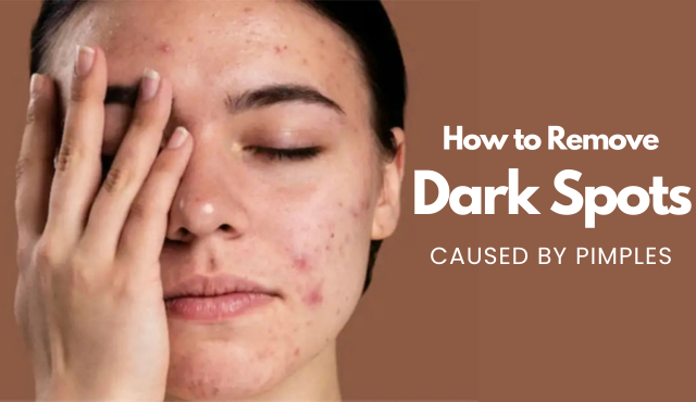 hoe to remobve dark spots